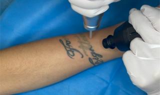 郑州洗纹身 郑州洗纹身